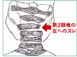 図 - 第３頸椎の左へのズレ